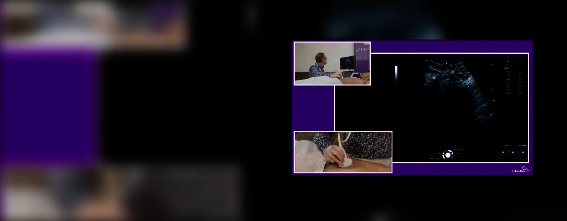 Dépistage échographique de l'anévrisme de l'aorte abdominale : une pratique essentielle en médecine générale